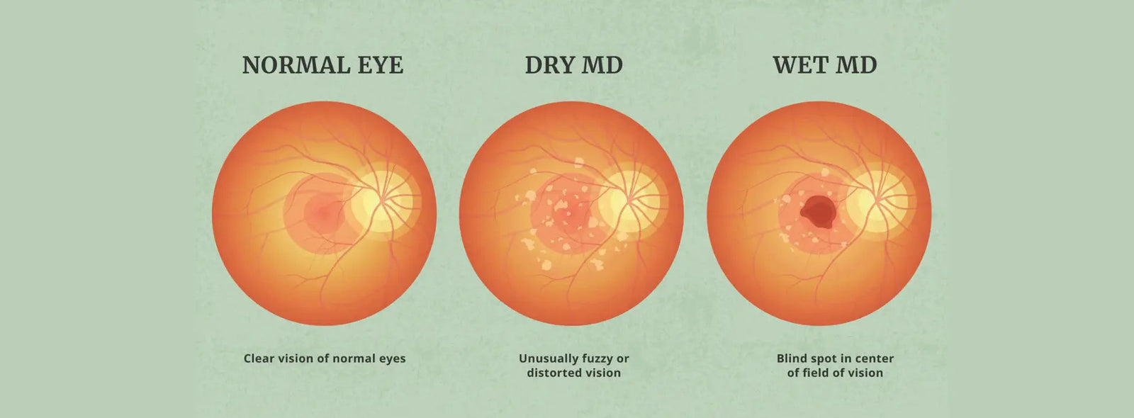 Illustration comparing dry and wet macular degeneration and how each affects the retina and central vision