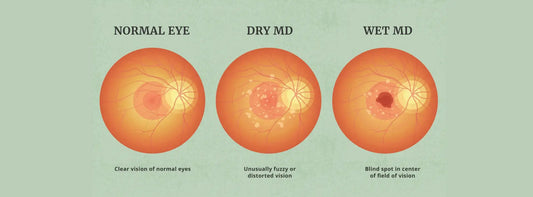 Illustration comparing dry and wet macular degeneration and how each affects the retina and central vision